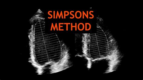 simpson's method echocardiogram.